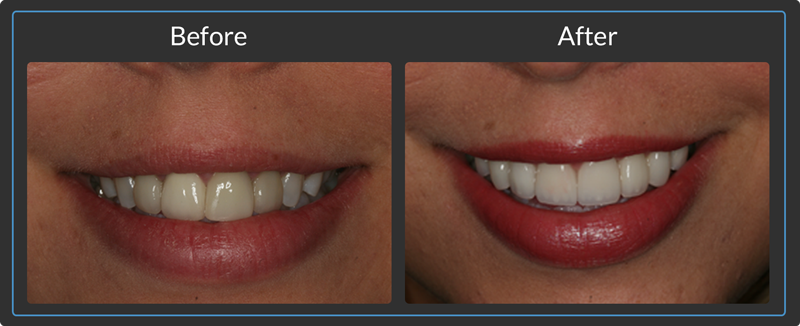 Before & After Dental Inlays & Onlays in Orange County