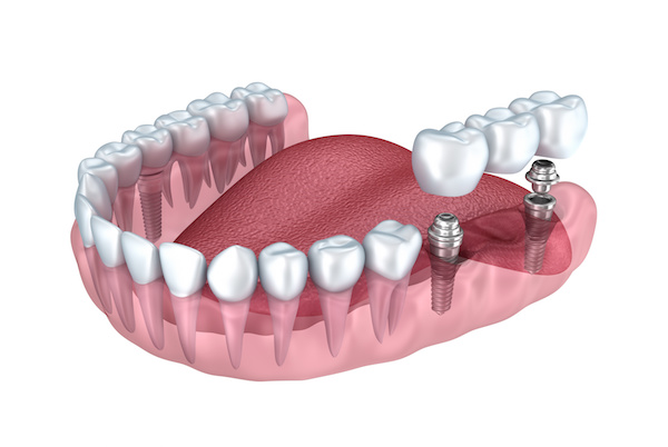 Implant bridge