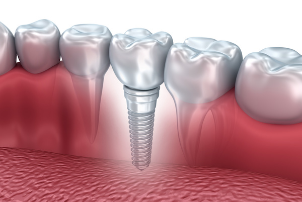 Single tooth implant 