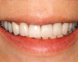 After Ceramic Crowns | Orange Center for Cosmetic Dentistry