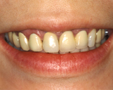 Before Dental Crowns | Orange Center for Cosmetic Dentistry