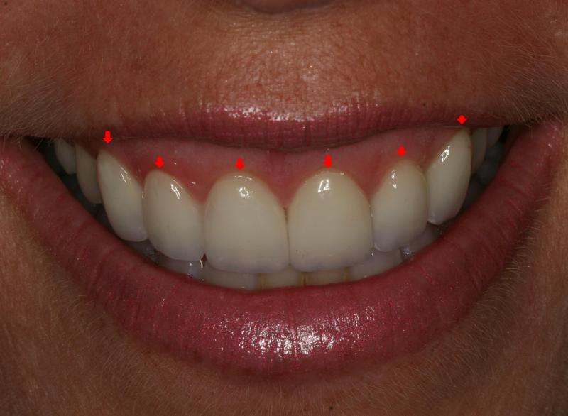 Gum line symmetry in a smile makeover | Orange CA 