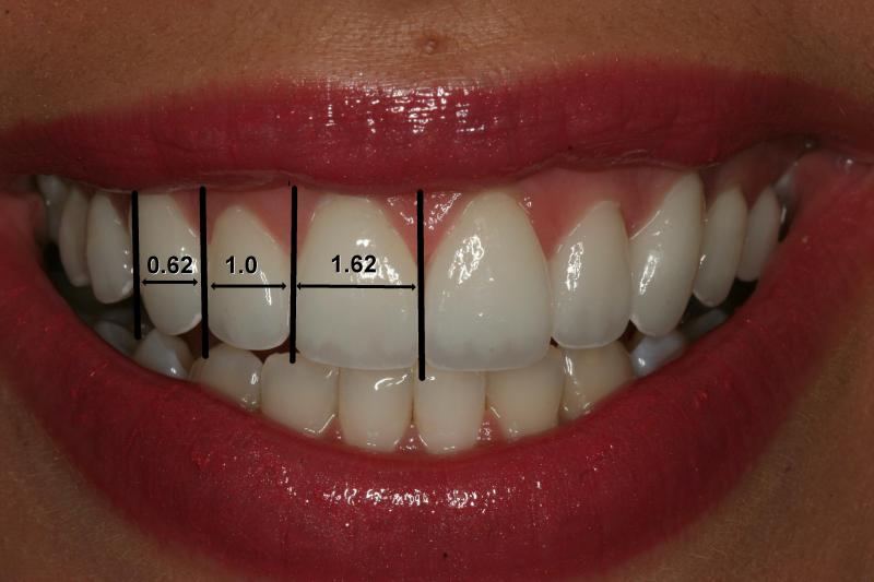 Golden Proportion Smile | Orange Center for Cosmetic Dentistry