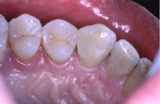 Metal-Free Dentistry | Orange County CA