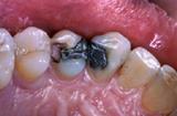 Old metal fillings before replacement with white fillings - Example 1