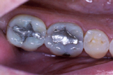 Old metal fillings before replacement with white fillings - Example 2