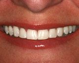 Orange County Teeth Whitening
