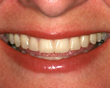 Orange County Teeth Whitening